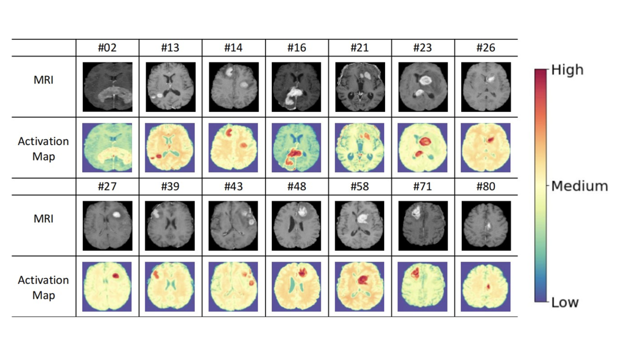 Image Deep Learning PCNSL