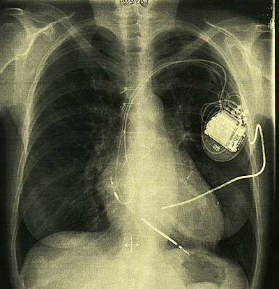 Roentgen Thorax mit Herzschrittmacher